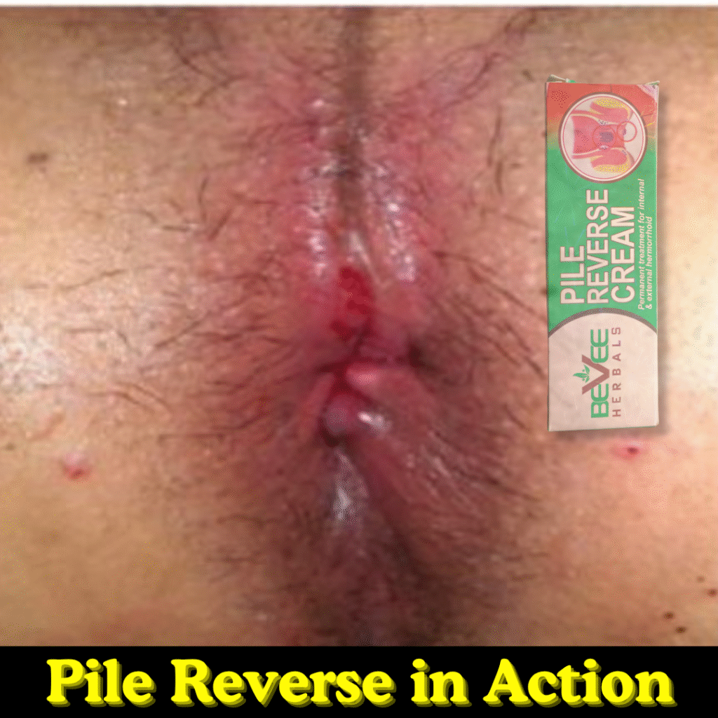 Pile Reverse Cream Hemorrhoid Capsule