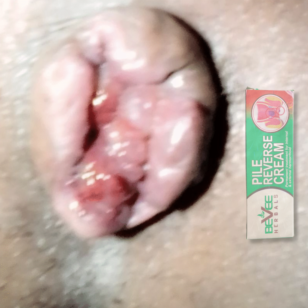 Pile Reverse Cream Hemorrhoid Reverse Capsule